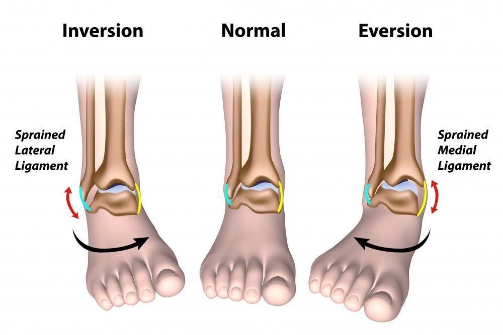 What is Chronic Ankle Instability?