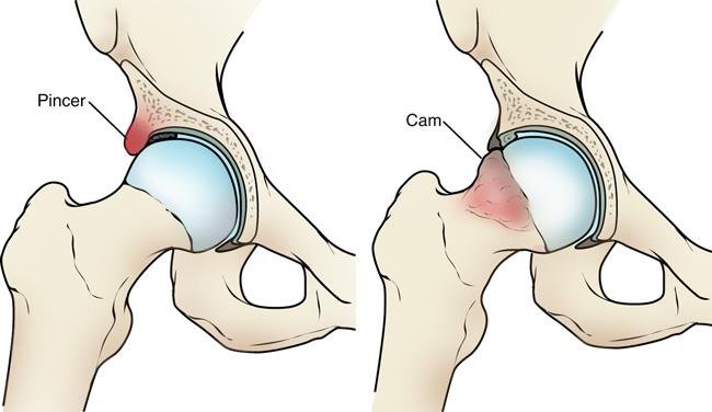 What is Hip Arthroscopy?