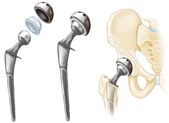 What is Avascular Necrosis (AVN) of the Hip?