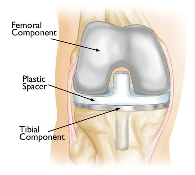 Who needs Knee Replacement Surgery?