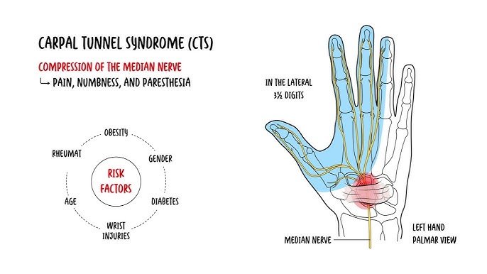 What is Carpal Tunnel Syndrome?