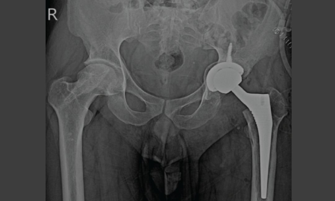 Hip Replacement Surgery